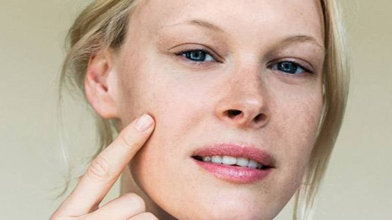 akne narben heilen und entfernen 768x432